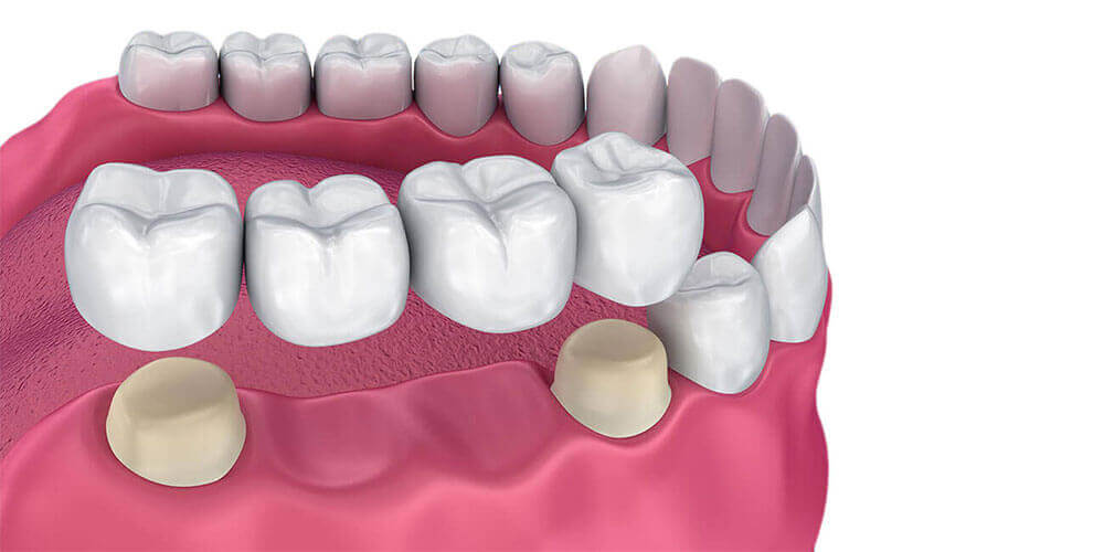 Dental Bridges Toronto