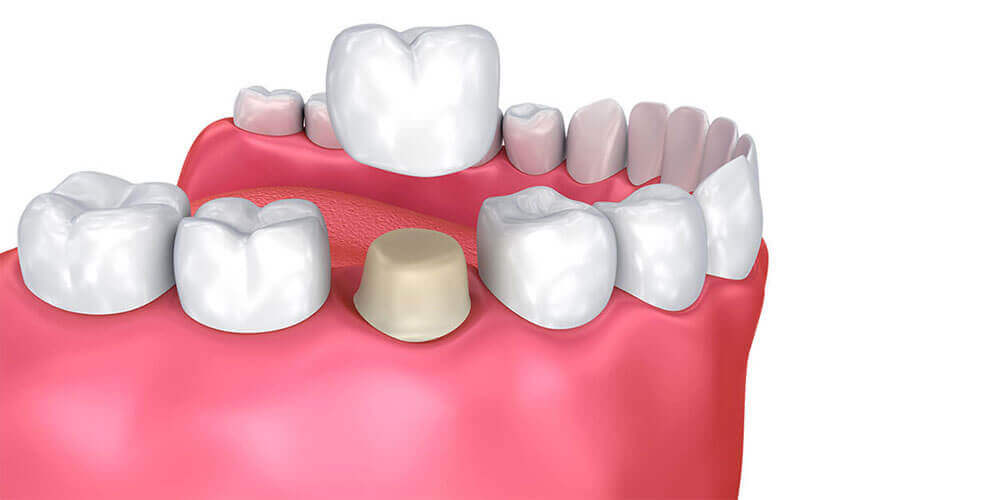 Dental Crowns Toronto