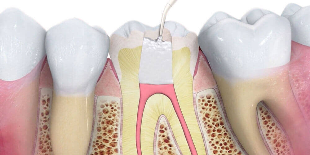 Root Canal Treatment Toronto